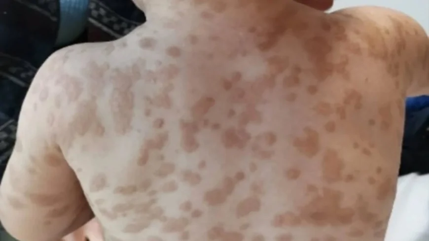 Uzman İsim Uyardı: Az Bilinen Hastalık Mastositoz'a Dikkat!